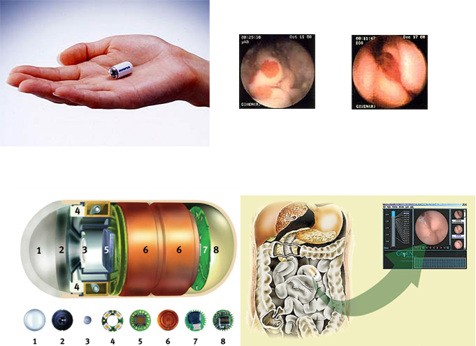 Капсульная эндоскопия презентация